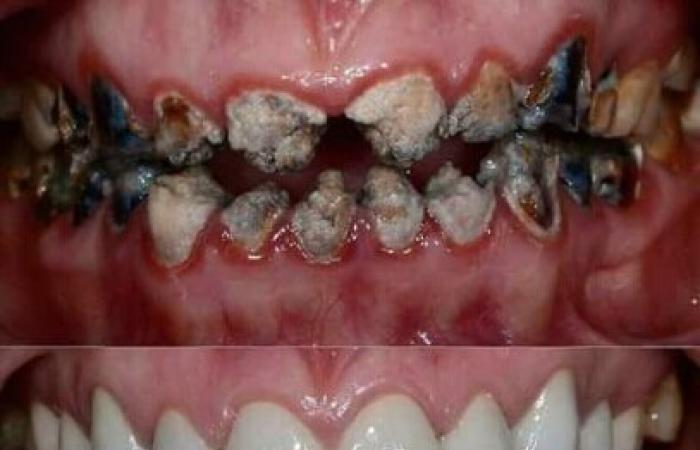 علاج الأسنان مجاناً في الإسكندرية